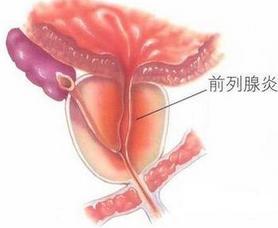 前列腺肿瘤