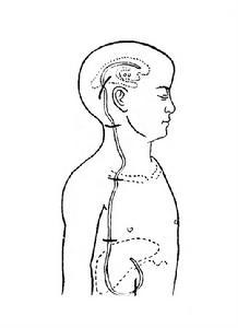 进行性面偏侧萎缩症
