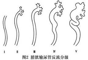 膀胱输尿管反流