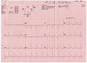 变异性心绞痛心电图