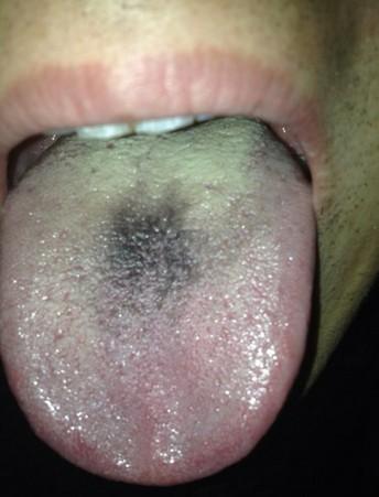 舌苔发黑