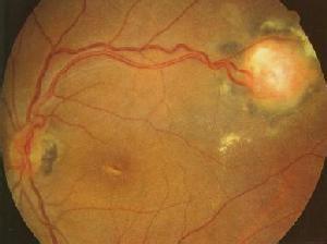 眼结膜血管瘤图片