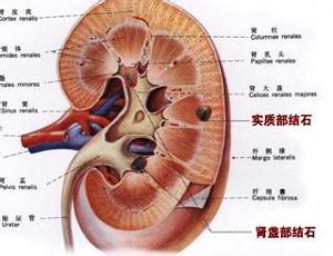 泌尿系统梗阻