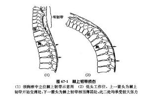 棘上韧带损伤