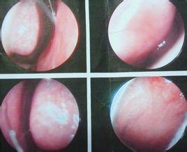 鼻甲炎症状图片图片