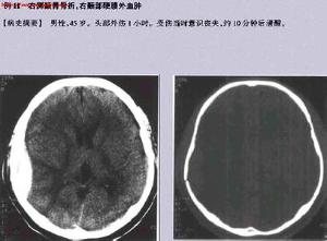 闭合性颅脑损伤