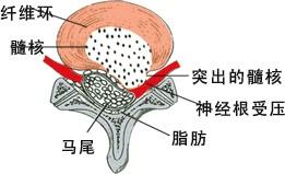 结核性脊髓炎