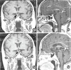 淋巴细胞性垂体炎