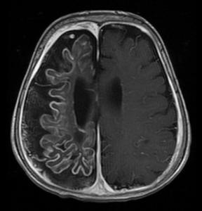 淋巴细胞性垂体炎