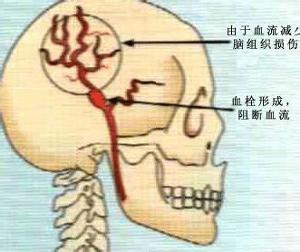 慢性硬脑膜下血肿