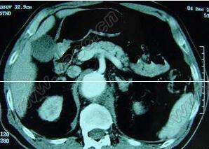 先天性主动脉瓣窦动脉瘤破裂