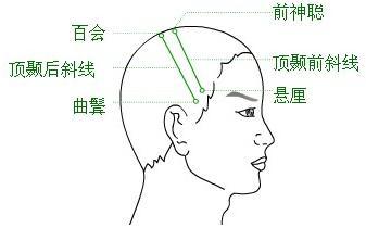 头皮针结构图图片