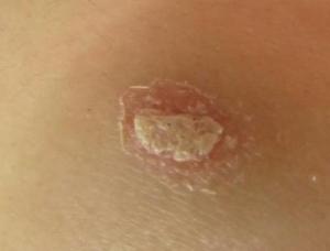 4中医治疗皮损呈散在的约五分硬币大小的圆形红色斑片,其上可发生丘疹