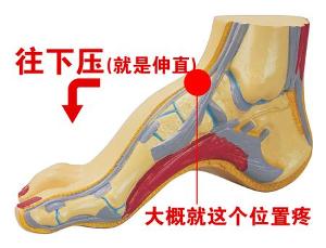 跟骨痛