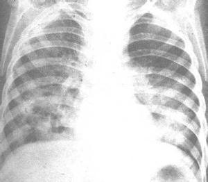类肺炎性胸腔积液