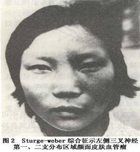 斯特奇-韦伯综合征
