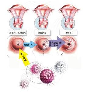 宫颈白斑偶与非典型增生,原位癌或早期浸润癌并存,认为宫颈白斑的发生