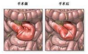 绞窄性肠梗阻