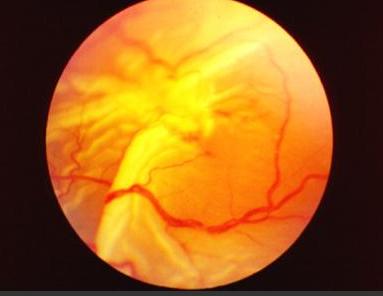 增生性玻璃体视网膜病变