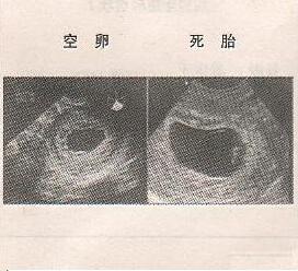 死胎外观描述图片