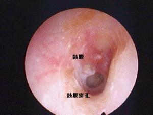 中耳乳突炎图片