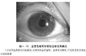 金黄色葡萄球菌性边缘性角膜炎