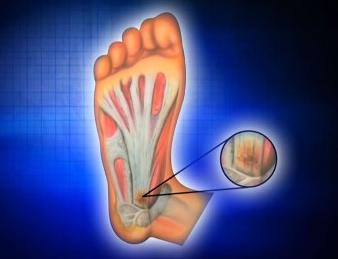 下床踩地時痛到寸步難行 預防 足底筋膜炎 4方法 康健雜誌