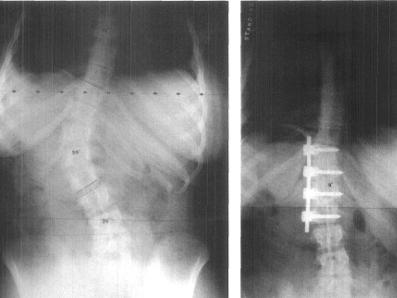 代偿性腰椎前凸