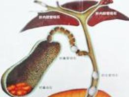 肝外胆管结石