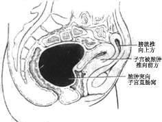 慢性输卵管卵巢炎