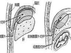 膈下感染