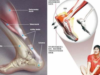 肌腱断裂