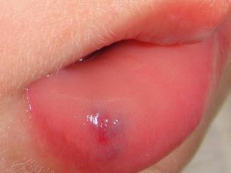 嘴唇血管瘤初期图片