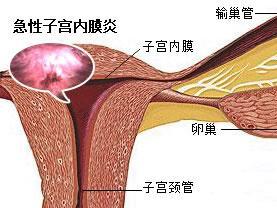 急性子宮內膜炎 - 搜狗百科