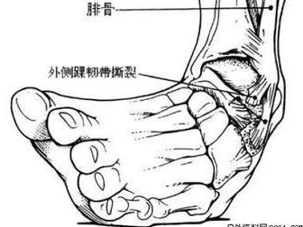 肢体内翻