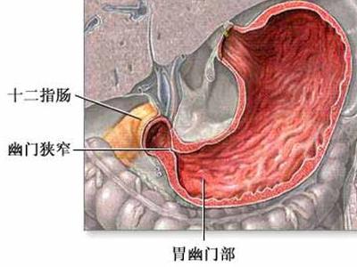 幽门狭窄