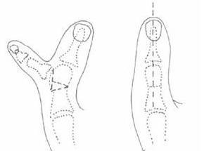 拇指仅存软组织而无骨骼