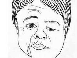 面纹消失