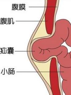 腹壁间疝