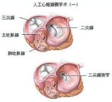 人工瓣膜