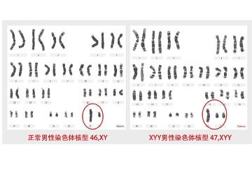 超雄綜合症