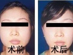 瘦脸手术
