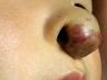 鼻血管瘤