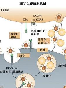 HIV感染