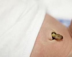 手术后刀口流液怎么办 0