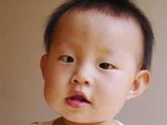 解剖性隐斜