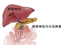 胰高血糖素瘤