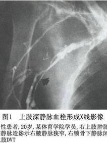 上肢深静脉血栓形成