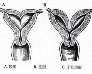 双角子宫 - 搜狗百科