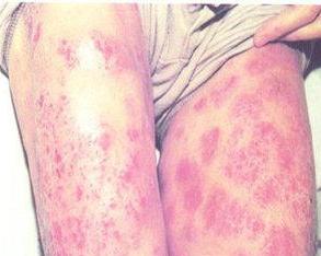 血风疮 - 搜狗百科